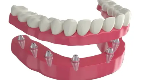 Prótesis Dentales