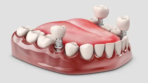 Prótesis Dentales