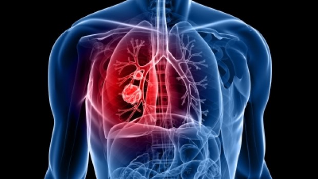 Según estadísticas nueve de cada diez casos de cáncer de pulmón son ocasionados por el tabaco imagen 1